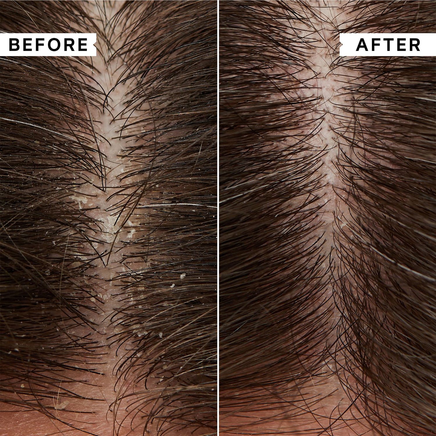 Flaky Scalp Anti-Dandruff Shampoo