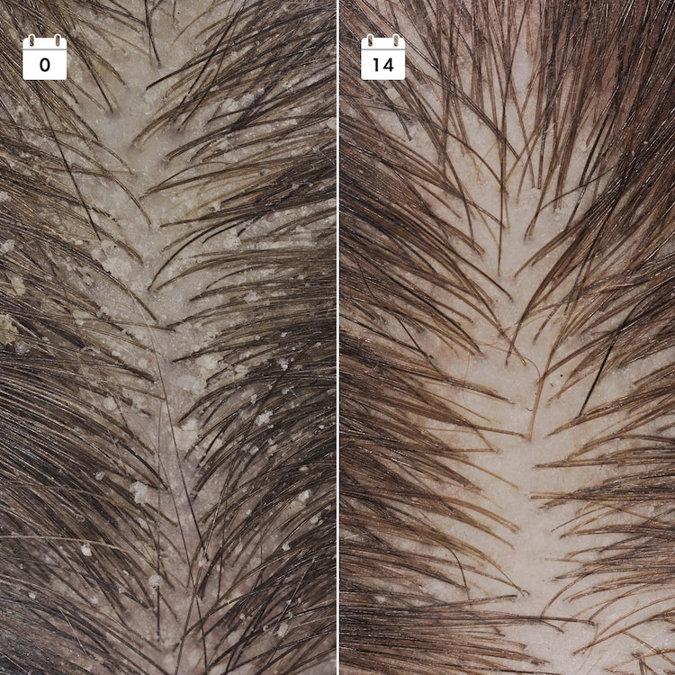Serum Anti-Pelliculaire Anti-Recidive - Serum för hårbotten