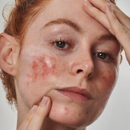 Otopina za crvenilo s 10% azelaične kiseline - Serum za lice